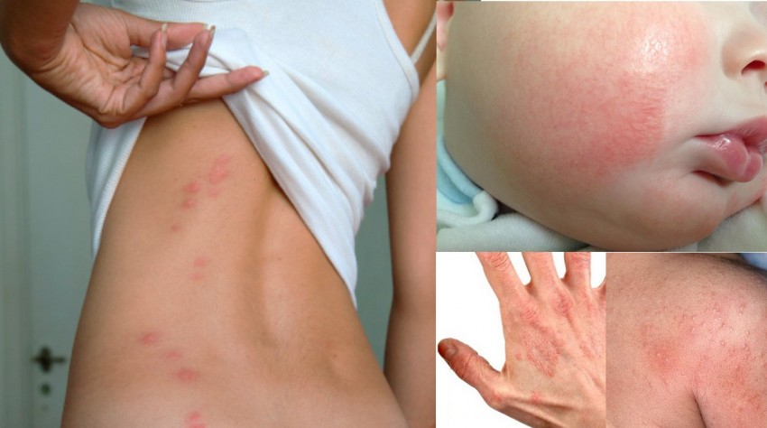 Аллергический дерматит - причины появления, первые симптомы и лечение у детей и взрослых (видео + 130 фото)