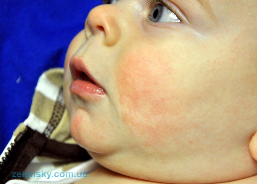 Аллергический дерматит - причины появления, первые симптомы и лечение у детей и взрослых (видео + 130 фото)