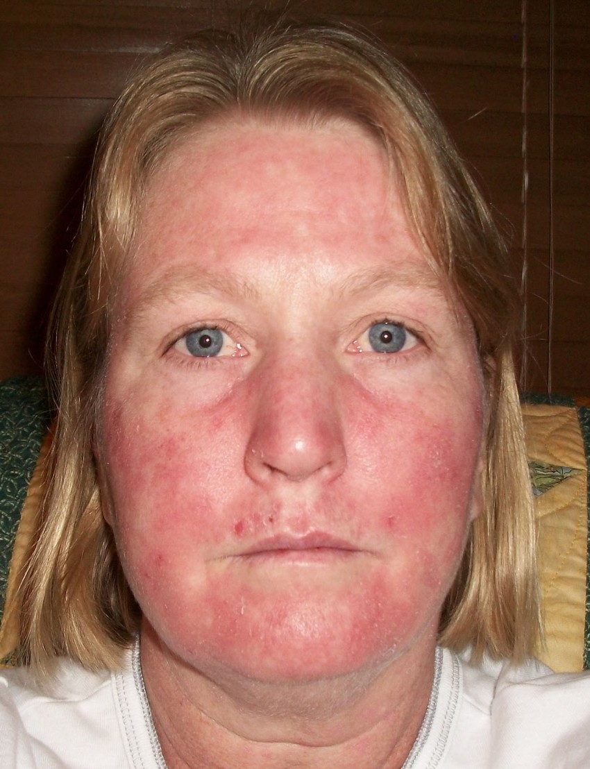 Виды сыпи при аллергии на лице