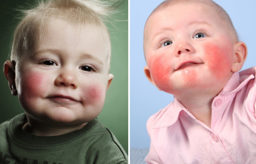 Пищевая аллергия на щеках у взрослого