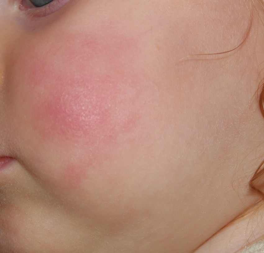 Аллергия на лице с картинками