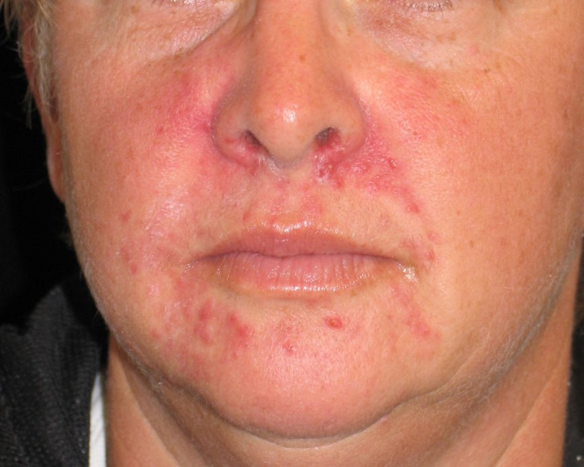 Аллергия на коже фото на щеке