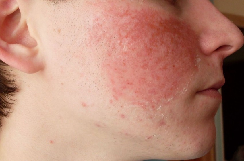 Аллергия на лице цвета кожи