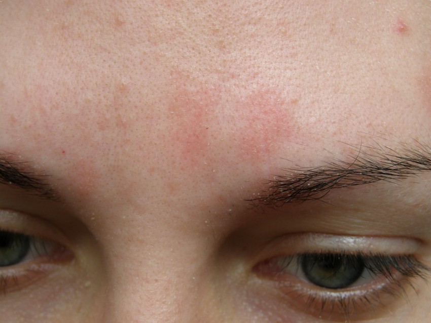 Как на лице проявляется аллергия фото