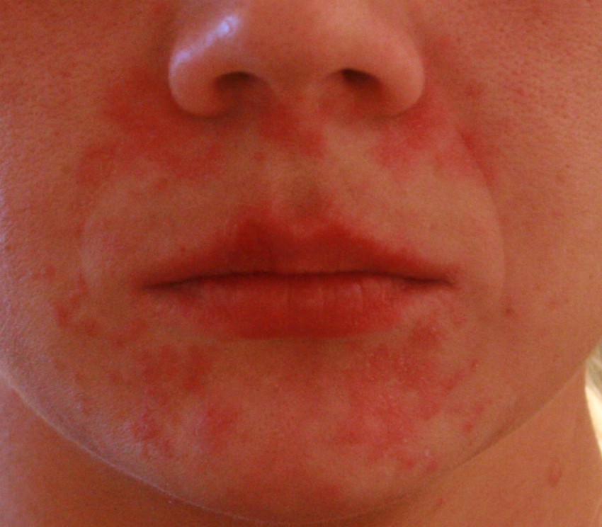 Проявление аллергии на лице фото