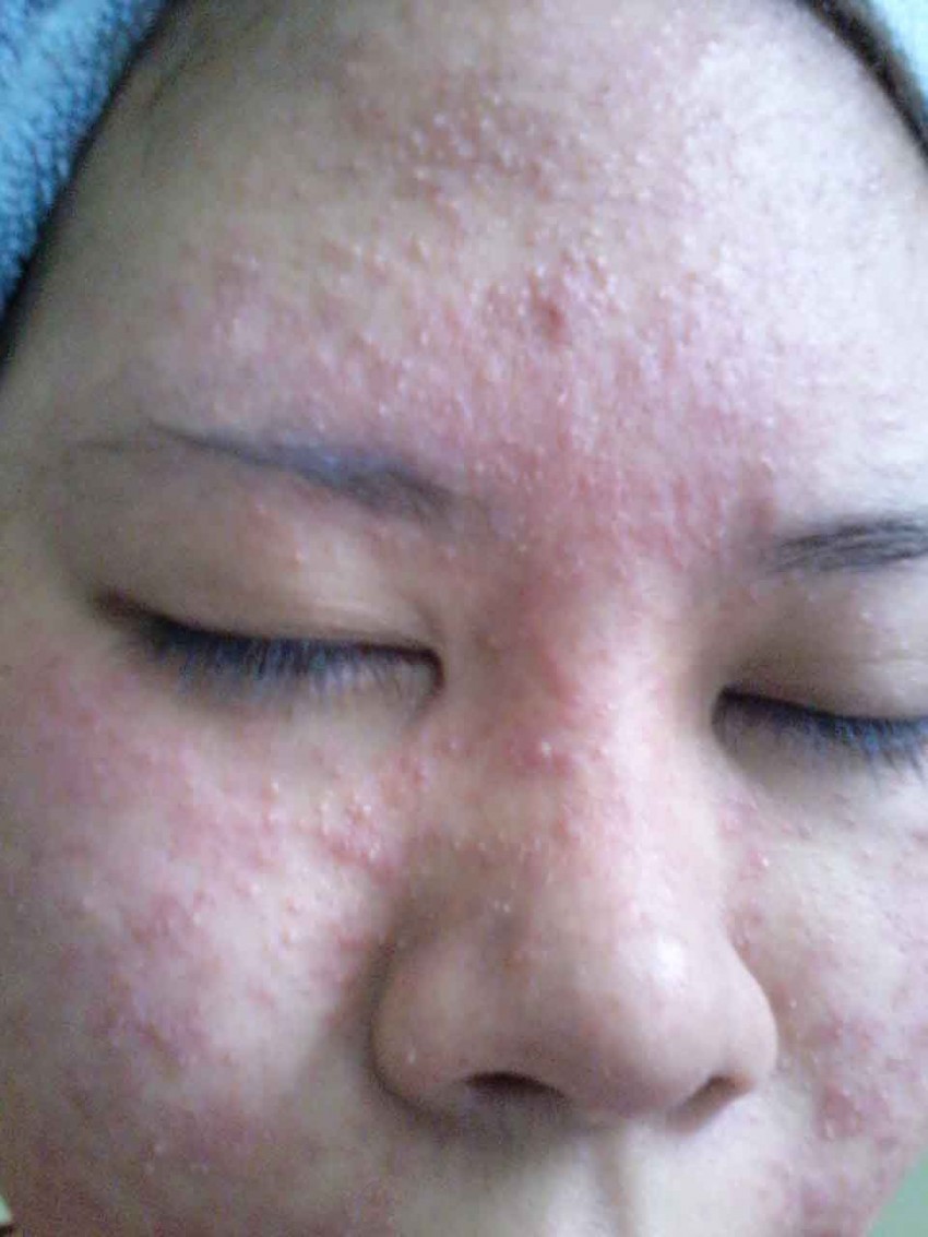 Аллергия в виде сыпи на лице фото