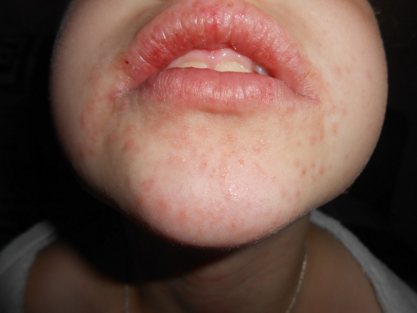 Аллергия на коже лица фото лечение