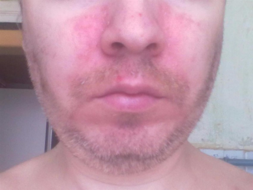 Аллергия в виде пятен на лице фото