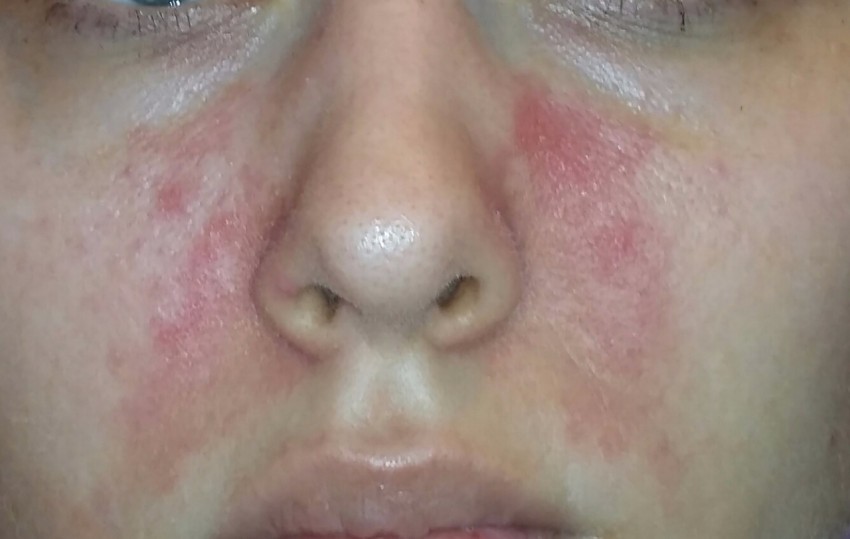 Аллергия в виде сыпи на лице фото