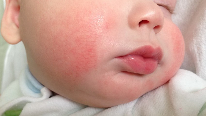 Аллергия на лице шелушение фото