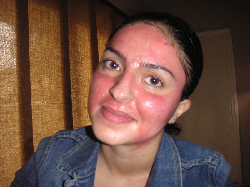 Проявление аллергии на лице фото