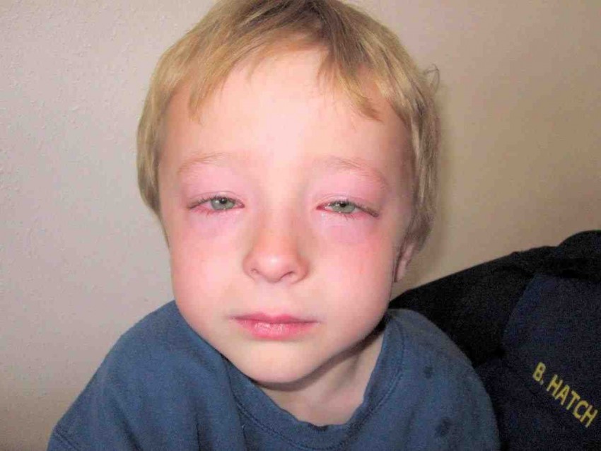 Хроническая аллергия на лице фото