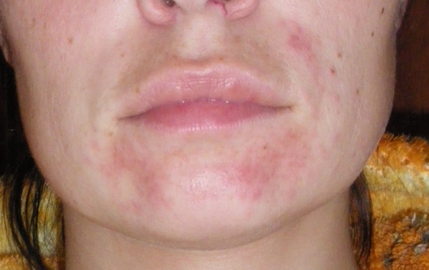 Аллергия на лице у взрослых чем лечить фото