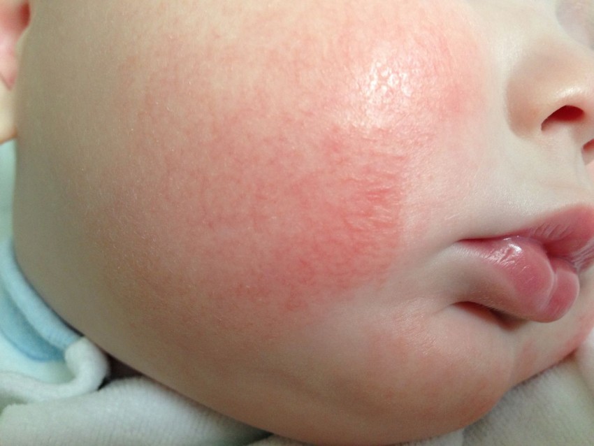 Фото сыпи лице аллергии