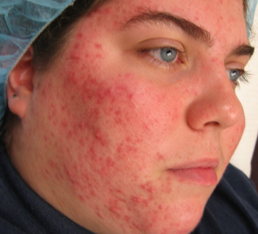 Фото аллергии у взрослых на лице фото thumbnail