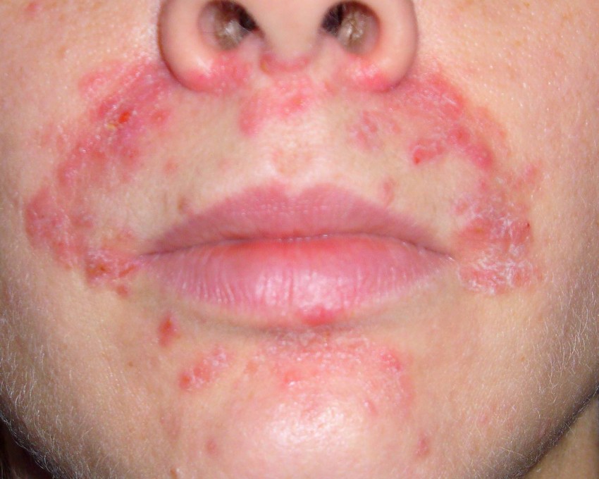 Аллергия на лице возле глаз фото