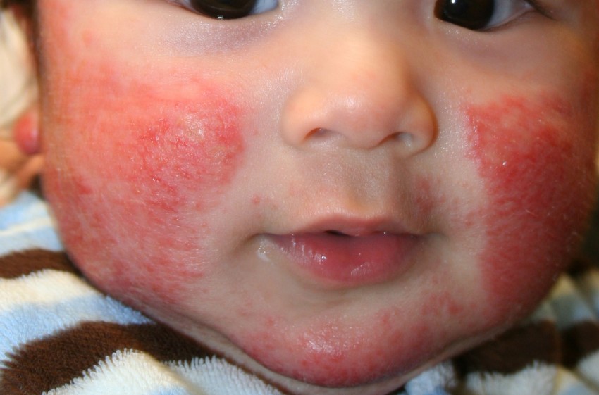 Алергия сыпь на лице фото