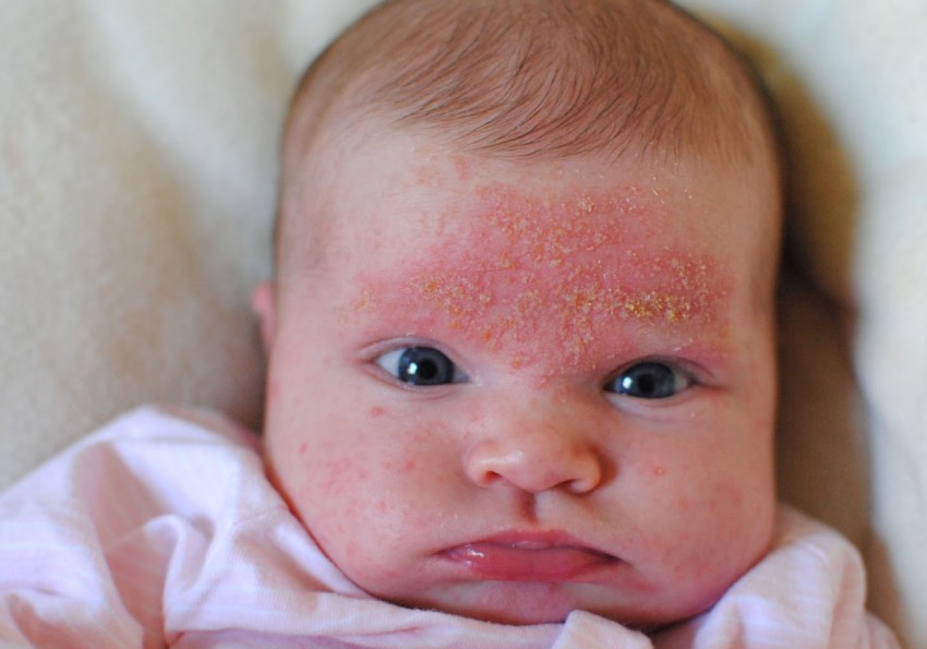 Аллергическая сыпь на лице у взрослого