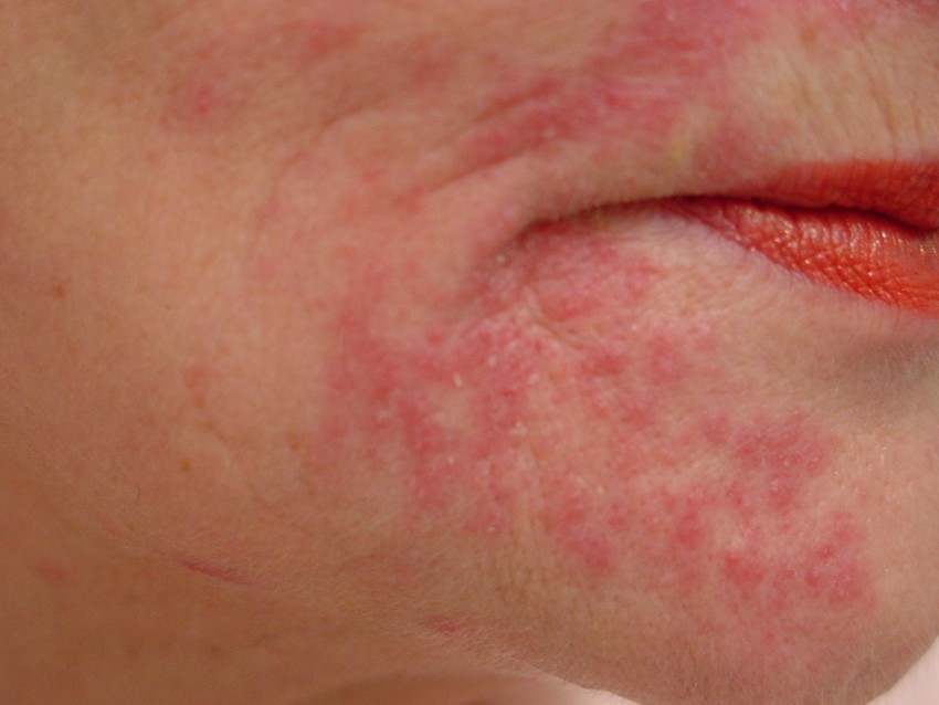 Как выглядит сыпь на лице при аллергии фото