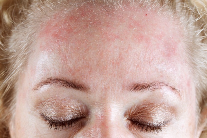 Проявление аллергии на лице у взрослых фото