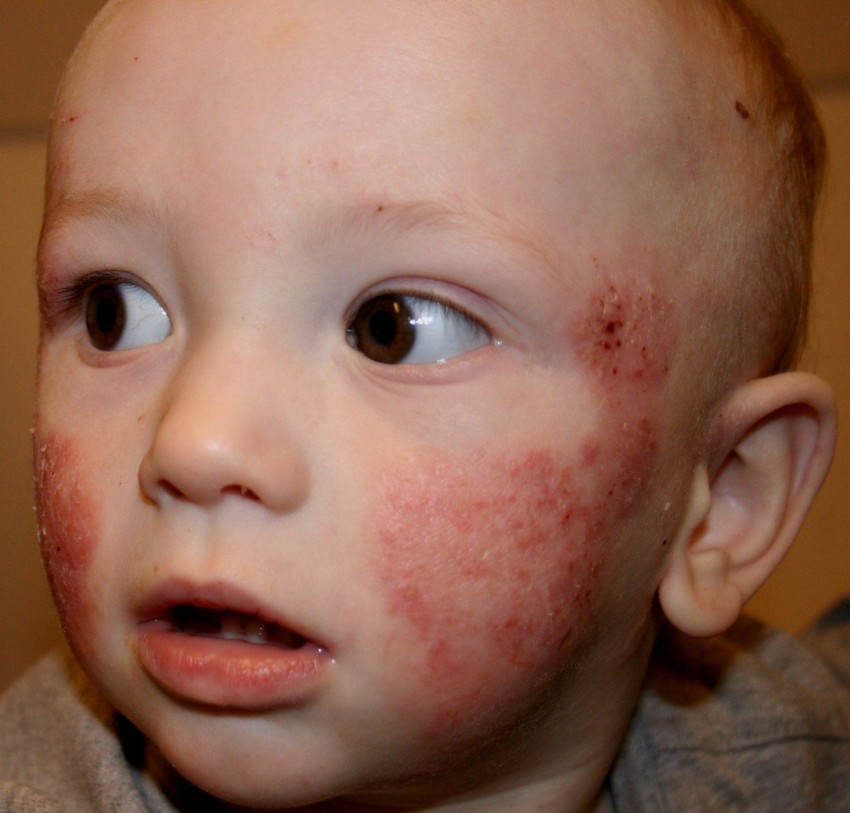 Аллергическая сыпь на лице фото лечение