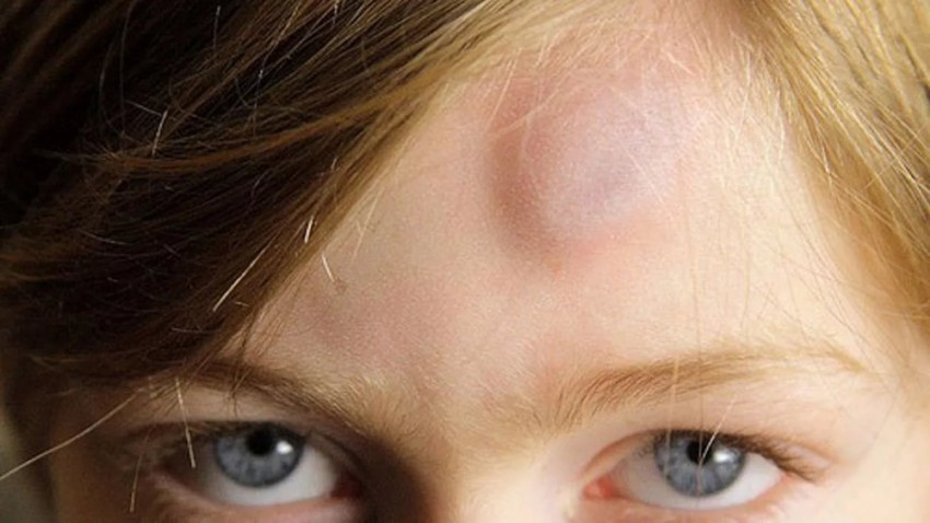 Атерома на голове: основные причины, важные симптомы и современные методы лечения (95 фото и видео)