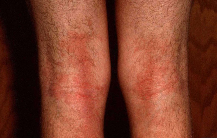 Атопический дерматит - как лечится заболевание кожи и к какому врачу следует обращаться с проблемой (100 фото)