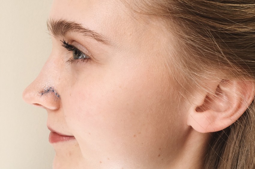 Новообразования на коже лица носа