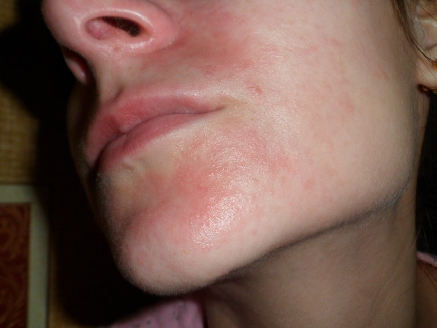 Новообразования на коже лица носа