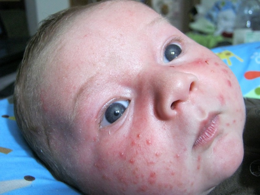 Фото дерматита на лице у взрослого