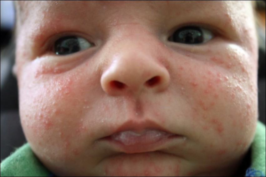 Фото дерматита на лице у взрослого