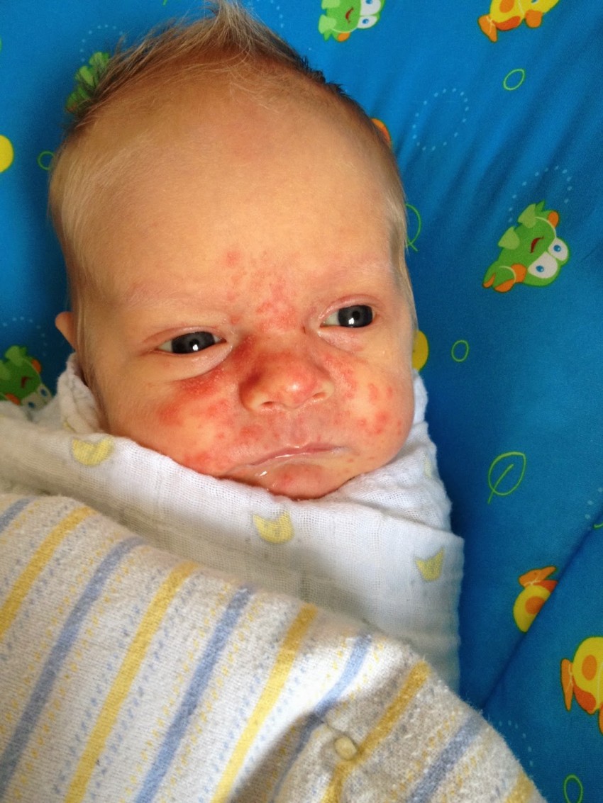 Фото дерматита на лице у взрослого thumbnail