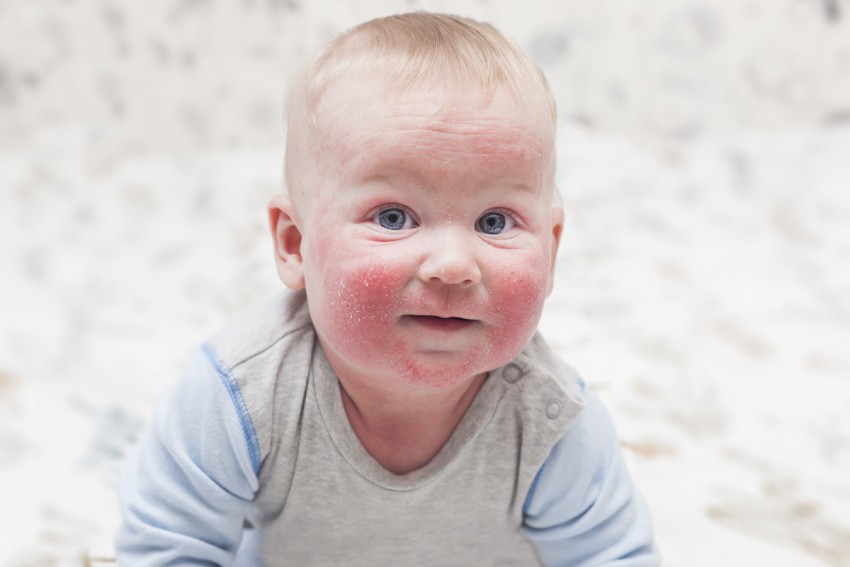 Атопический дерматит у детей - причины и лечение атопического дерматита у ребенка