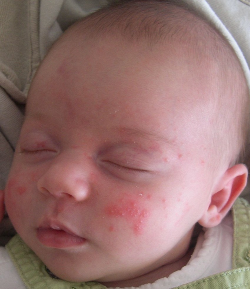 Аллергия диатез у детей фото thumbnail