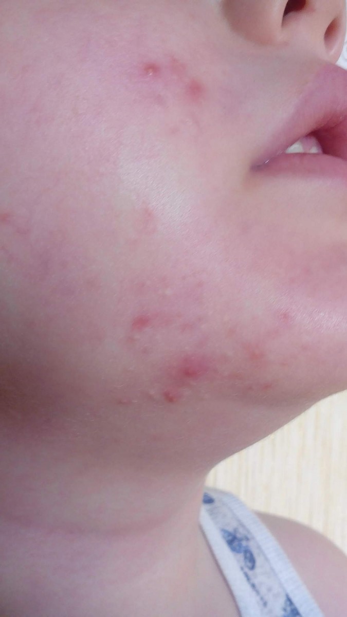 Аллергия диатез у детей фото