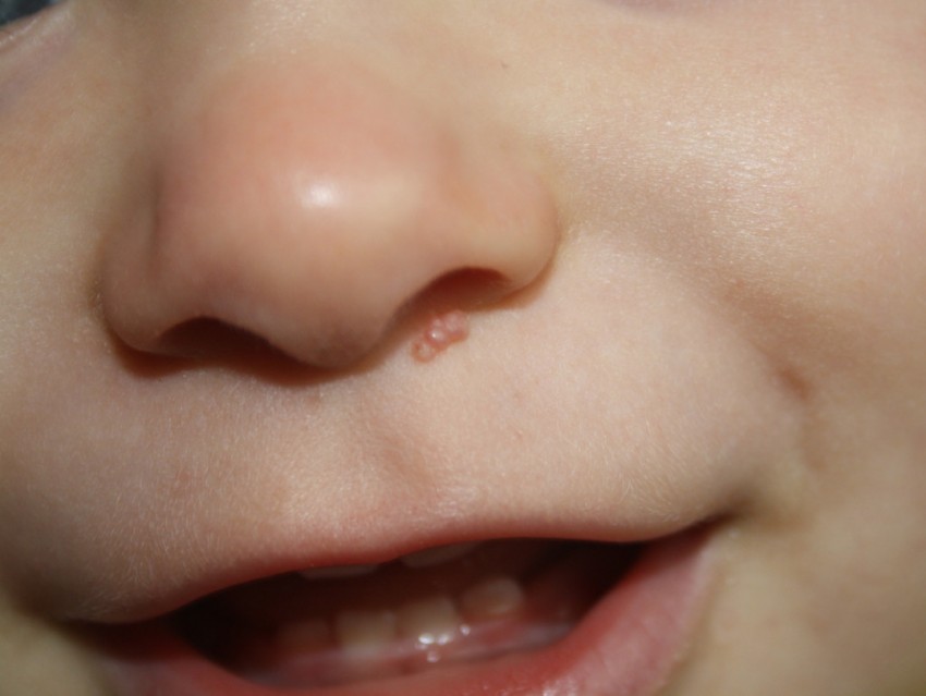 Аллергия диатез у детей фото