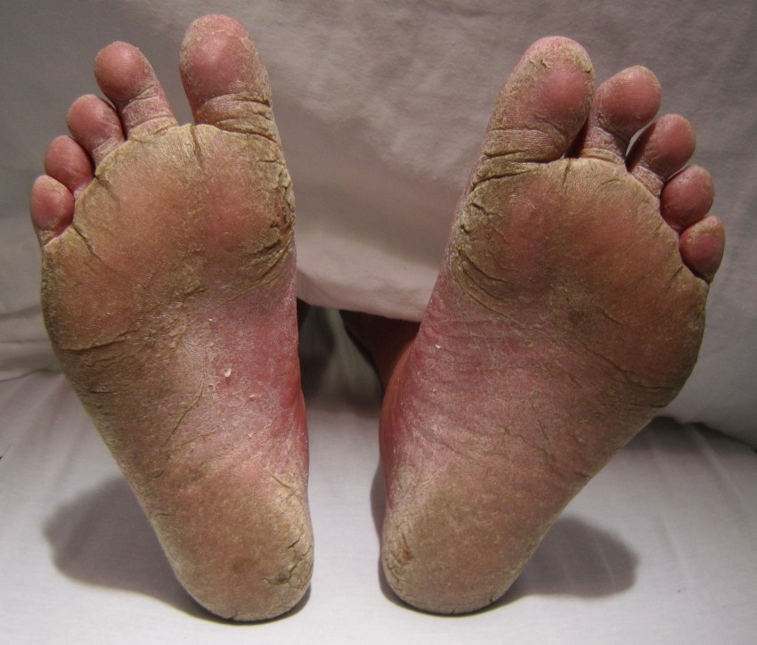 Грибок кожи стопы ног