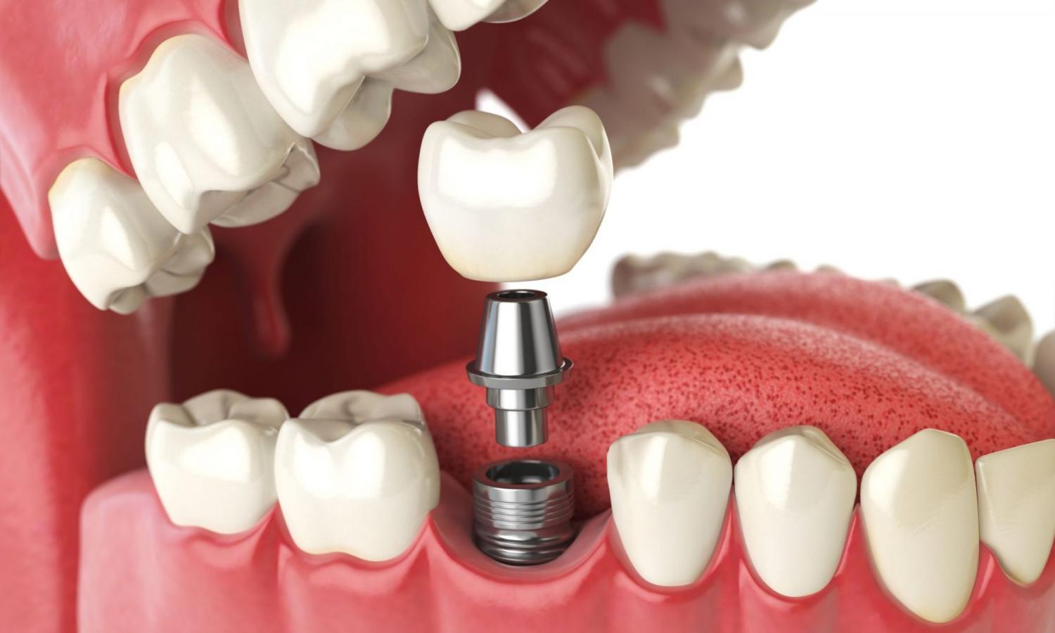 Имплантация зубов: методы установки + правила ухода