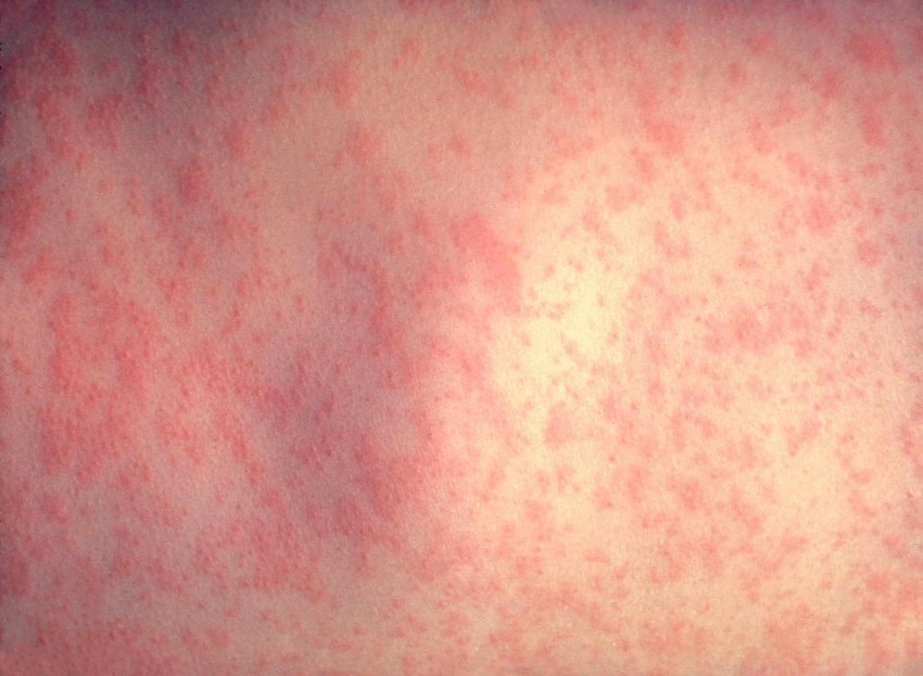 Лечение аллергии - проявления, диагностика и классификация аллергии. Советы дерматологов и аллергологов по выявлению аллергена