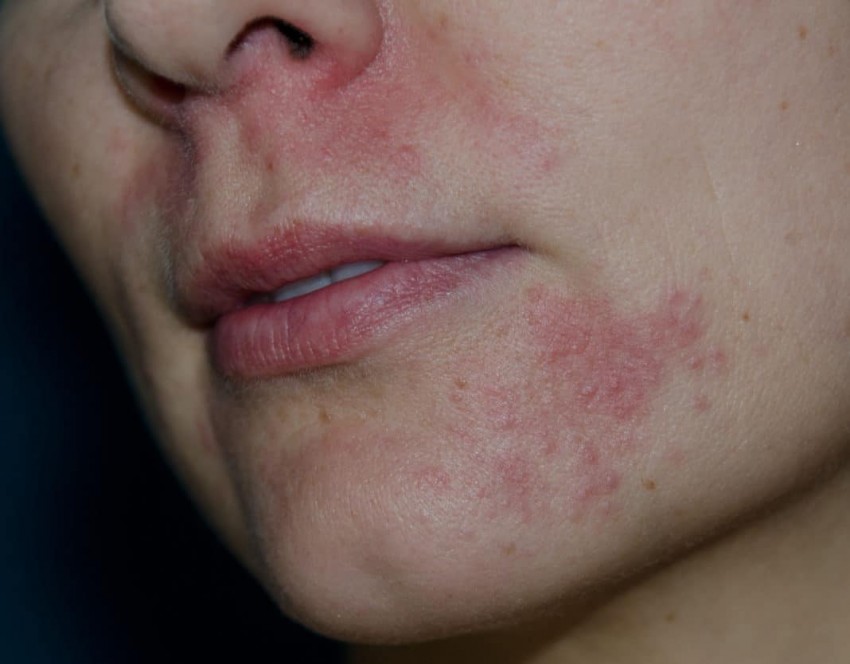 Лечение дерматита - профессиональные методы эффективного избавления от заболевания на разных участках кожи (105 фото)