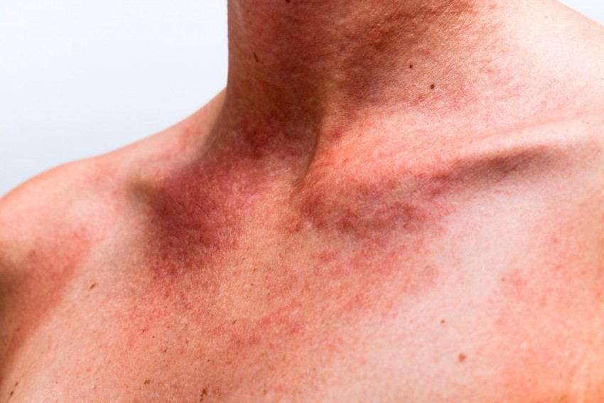 Лечение дерматита - профессиональные методы эффективного избавления от заболевания на разных участках кожи (105 фото)