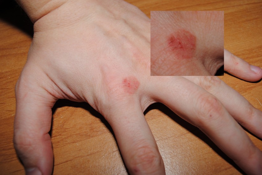 Прыщи на руках - причины появления, виды диагностика заболевания и избавления от прыщей. 115 фото самых распространенных проблем с кожей рук