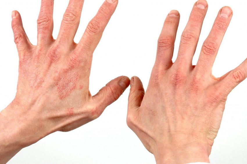 Прыщи на руках - причины появления, виды диагностика заболевания и избавления от прыщей. 115 фото самых распространенных проблем с кожей рук