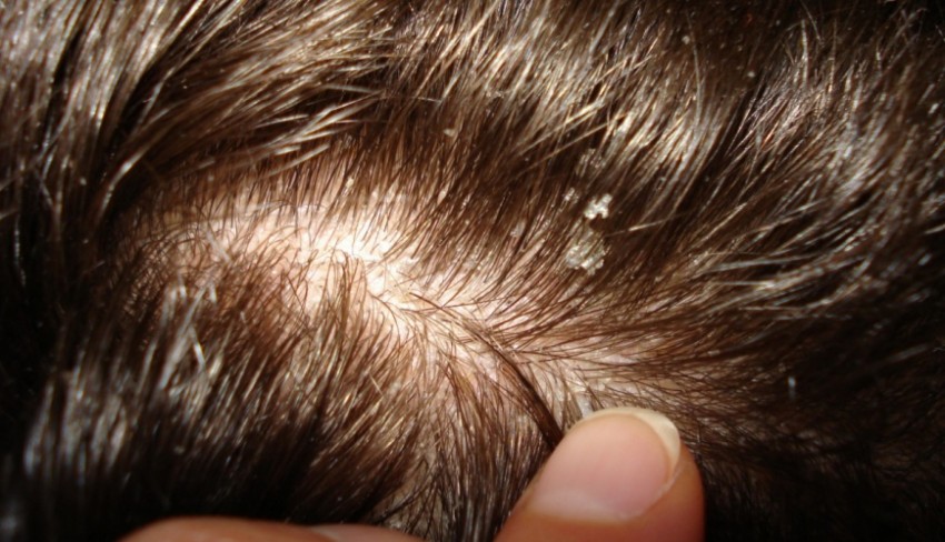 Как начинается псориаз кожи головы