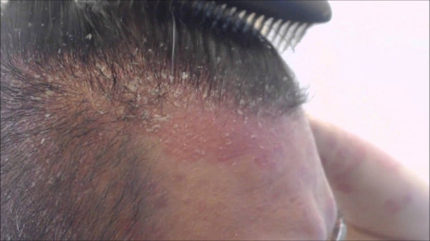 Как начинается псориаз кожи головы