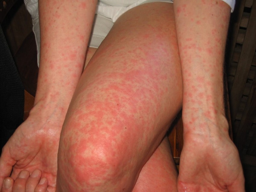 Симптомы аллергии - первые проявления, причины аллергии, прием препаратов широкого спектра действия и узконаправленное лечение (120 фото)