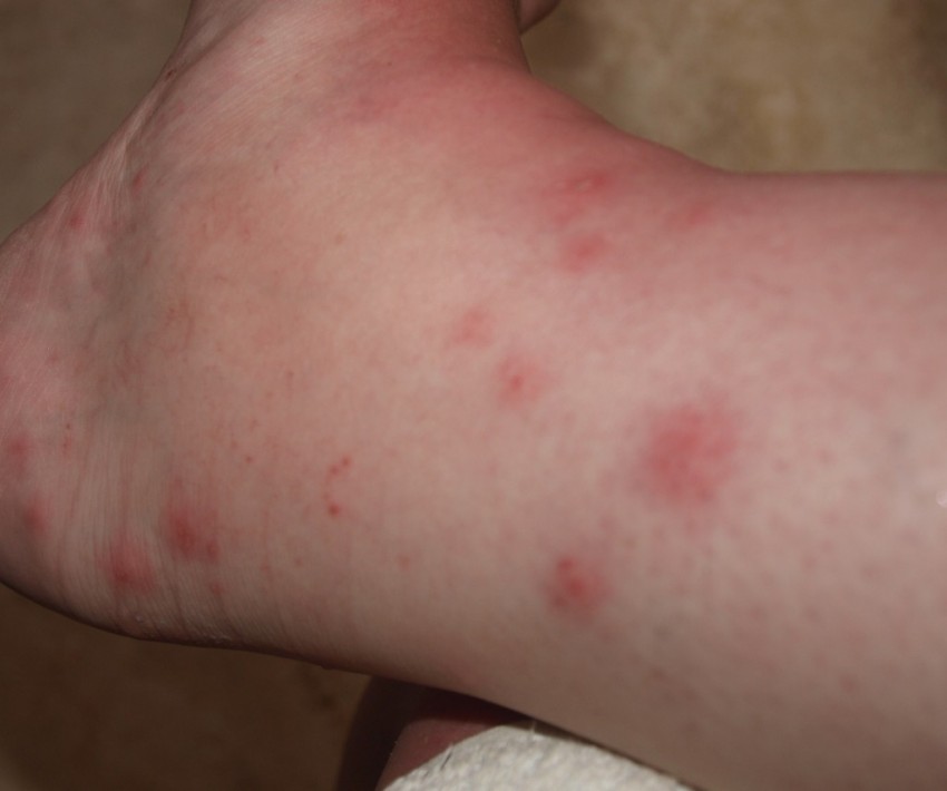 Симптомы аллергии - первые проявления, причины аллергии, прием препаратов широкого спектра действия и узконаправленное лечение (120 фото)