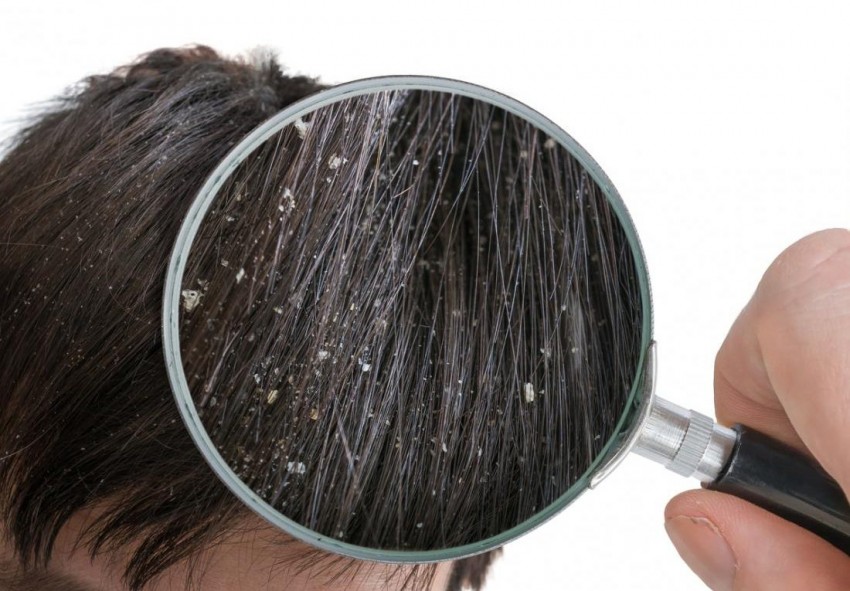 Лишай волосистой части кожи