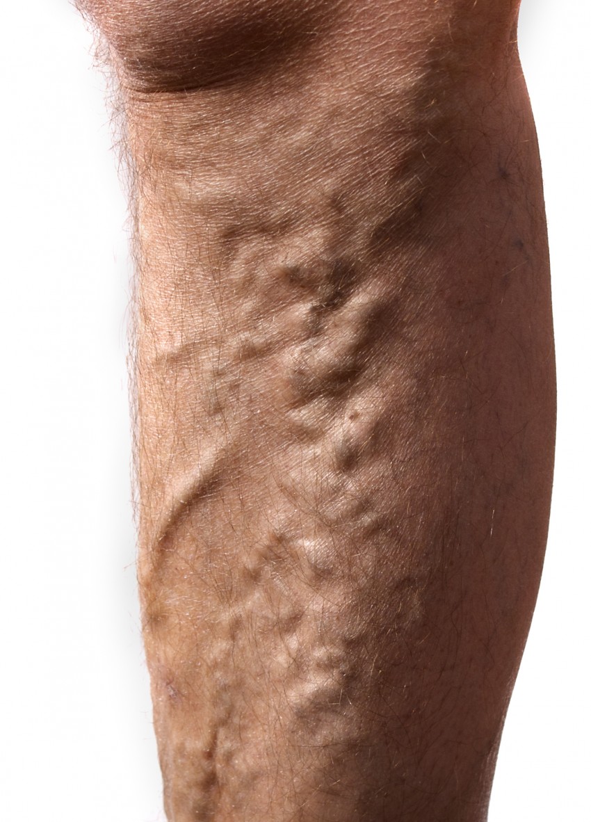Что такое варикозное расширение вен на ногах фото