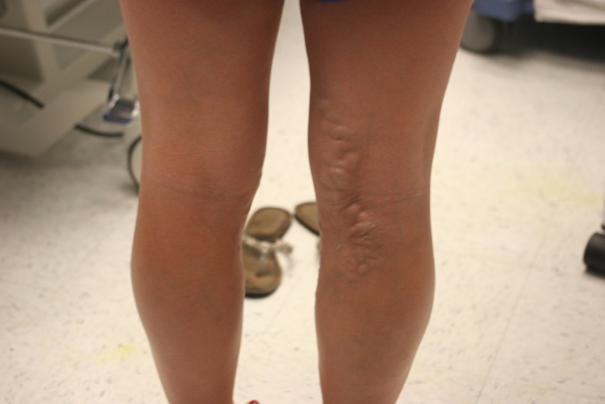 Что такое варикозное расширение вен на ногах фото причины